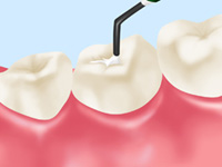 将来の歯の状態まで見据えた虫歯治療